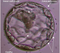 Διογκωμένη βλαστοκύστη (στάδιο 4). Το μέγεθος του εμβρύου είναι τώρα μεγαλύτερο της πλήρους βλαστοκύστης, ενώ η διάφανη ζώνη έχει λεπτύνει ως αποτέλεσμα της διόγκωσης του βλαστόκοιλου. Η έσω κυτταρική μάζα και η τροφοβλάστη αποτελούνται από πολλά κύτταρα σε πυκνή διάταξη. Θεωρείται άριστη βλαστοκύστη από πλευράς ανάπτυξης και μορφολογίας (4ΑΑ).