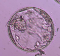 Διογκωμένη βλαστοκύστη ποιότητας 4ΑC με άριστη έσω κυτταρική μάζα και τροφοβλάστη με ελάχιστα κύτταρα. 
