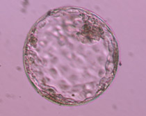 Διογκωμένη βλαστοκύστη ποιότητας 4ΒC. Η έσω κυτταρική μάζα αποτελείται από αρκετά κύτταρα σε αραιή διάταξη και η τροφοβλάστη από ελάχιστα κύτταρα.