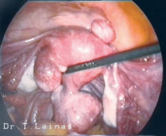 Laparoscopic image of subserous uterine fibroids