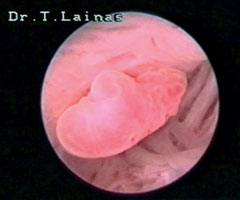 Ενδοτραχηλικός πολύποδας (υστεροσκοπική εικόνα).