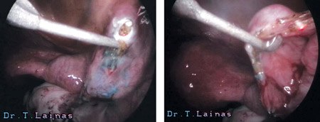 Σαλπιγγοστομία: Η υδροσάλπιγγα διανοίγεται με τη βοήθεια ειδικών αγκίστρων και laser CO2. (λαπαροσκοπική εικόνα).