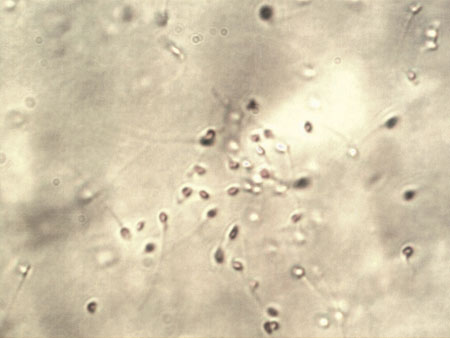 Τα σπερματοζωάρια όπως απεικονίζονται στο μικροσκόπιο (μεγέθυνση x 500 - αρχείο ΕΥΓΟΝΙΑΣ).
