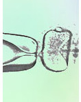 Intracytoplasmic Sperm Injection (ICSI)