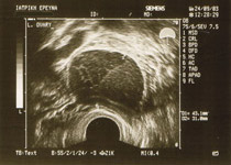 Ωχραιμάτωμα αριστερής ωοθήκης όπως απεικονίζεται σε διακολπικό υπερηχογράφημα (αρχείο ΕΥΓΟΝΙΑΣ).