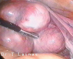 Laparoscopic image of subserous uterine fibroids