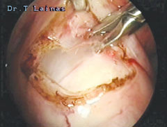 Removal (enucleation) of uterine myoma laparoscopically with the use of CO2 laser