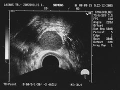 Ενδομητριωσική κύστη δεξιάς ωοθήκης. Χαρακτηριστική εικόνα σε διακολπικό υπερηχογράφημα (αρχείο ΕΥΓΟΝΙΑΣ).