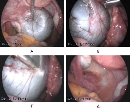 A: Left paraovarian cyst. The uterus, left ovary and oviduct are also visible. B,C: Removal of the cyst cortex using laser CO2. D: End of operation. All anatomical relations have been reinstated and the left oviduct remains untouched.