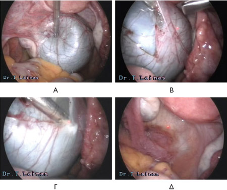Αφαίρεση παραωοθηκικής κύστης (λαπαροσκοπικές εικόνες).Α: Παραωοθηκική κύστη αριστερά. Διακρίνονται επίσης η μήτρα, η αριστερά ωοθήκη και η σάλπιγγα.Β, Γ: Αποφλοίωση της κύστης με laser CO2.Δ: Στο τέλος της επέμβασης οι ανατομικές σχέσεις έχουν αποκατασταθεί και η αριστερή σάλπιγγα παραμένει άθικτη.
