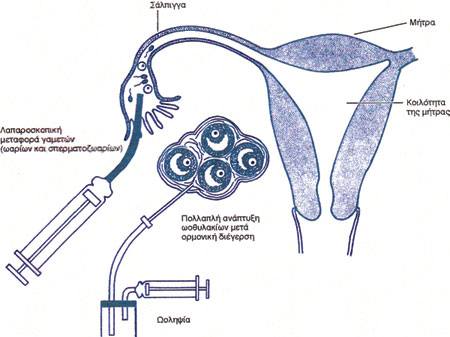 Σχηματική παράσταση GIFT. Μετά την πολλαπλή ωοθυλακική ανάπτυξη ακολουθεί συνήθως διακολπική ωοληψία. Η έγχυση ωαρίων και σπερματοζωαρίων πραγματοποιείται λαπαροσκοπικά στον αυλό της σάλπιγγας.